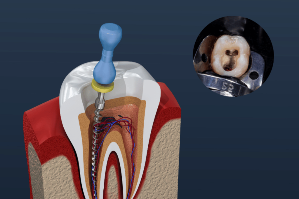 Tooth with a crown placed after root canal treatment for protection and strength