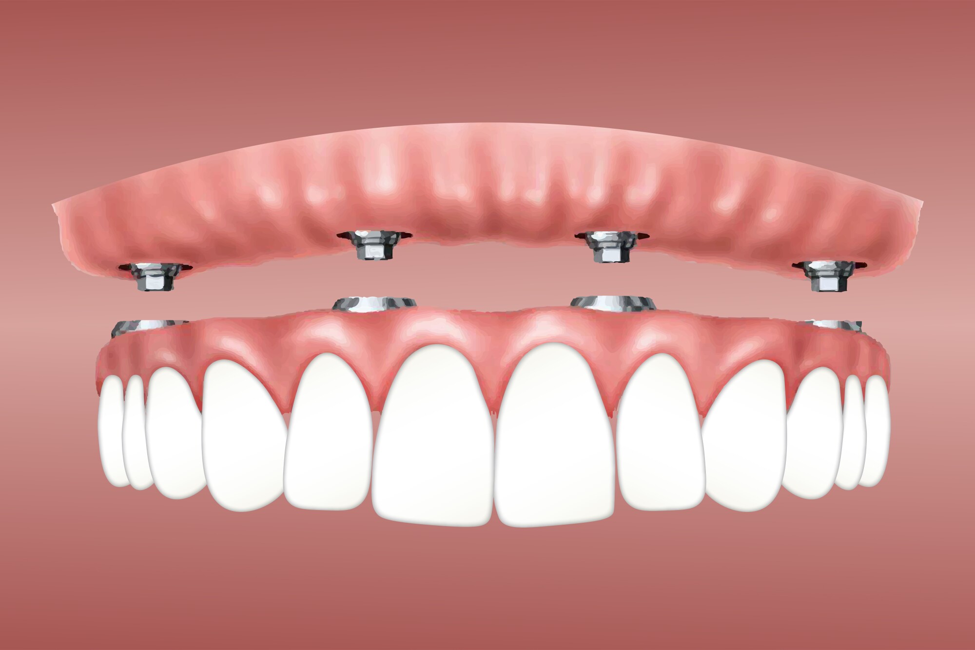 How Dental Implants Help Prevent Bone Loss
