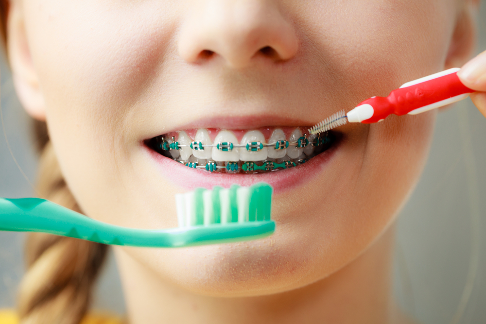 How to Maintain Oral Hygiene with Braces