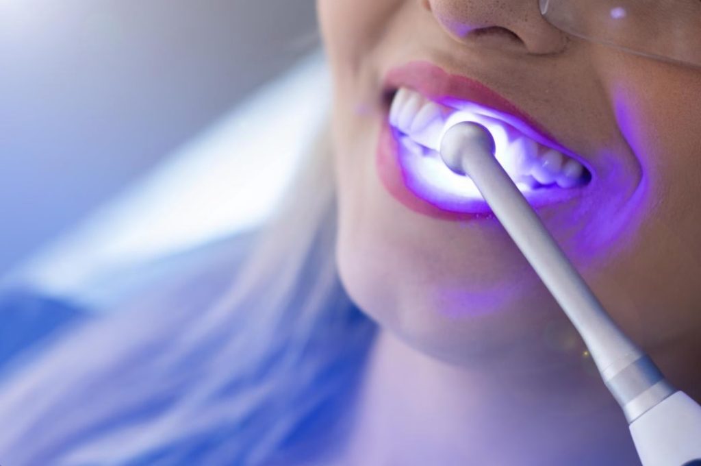 teeth acwhitening dentist in windsor