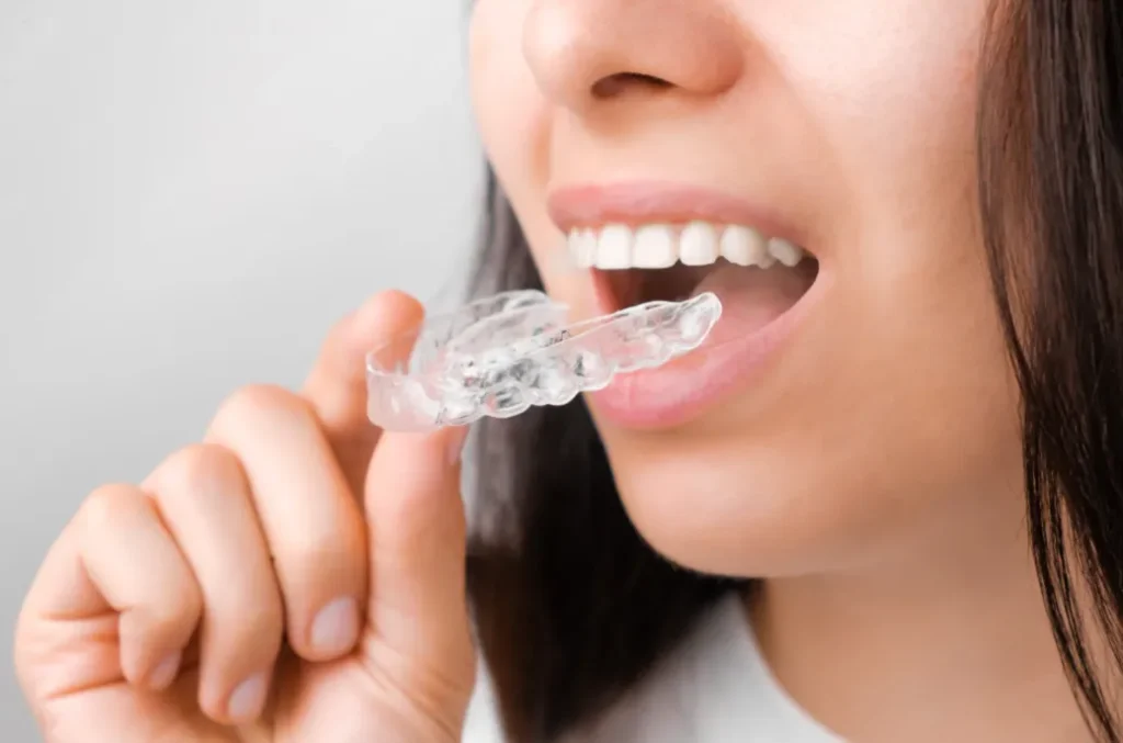 clear aligners know how