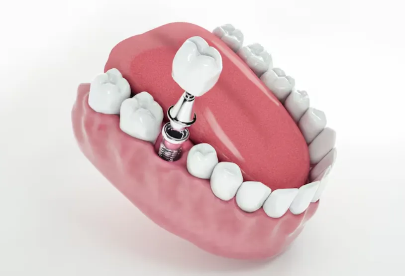 when to get dental implants