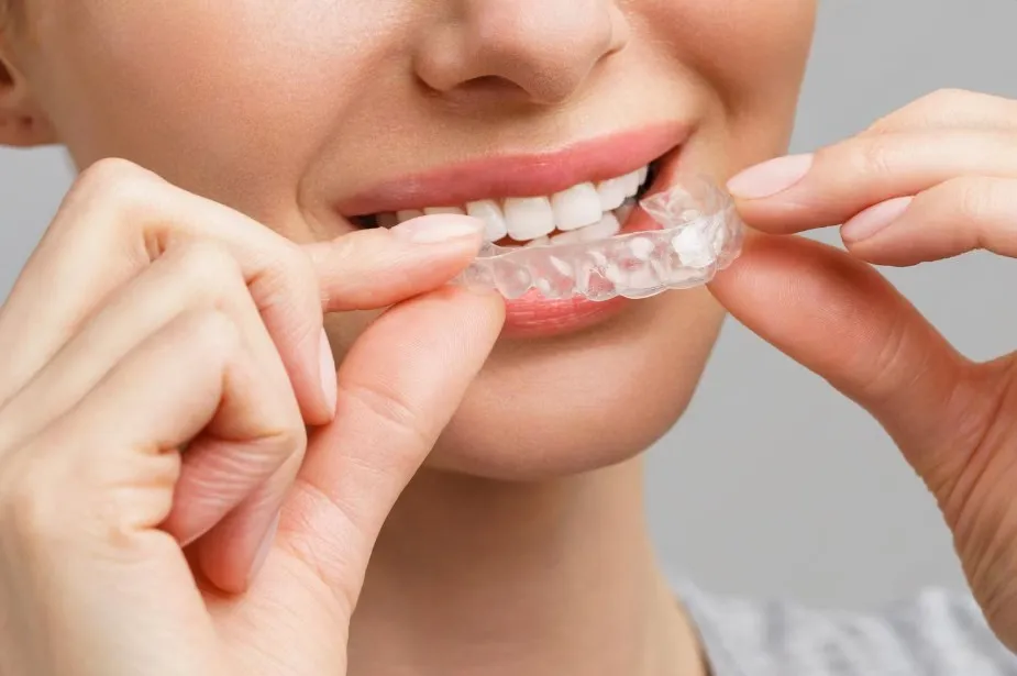 how clear aligners move teeth science